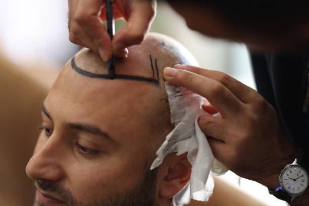 Step-by-Step Overview of the Hair Transplant in Dubai Experience
